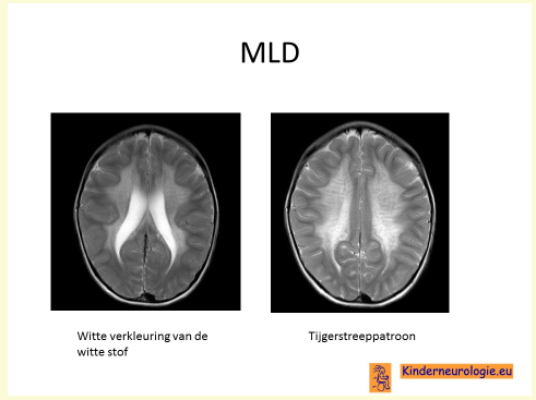 MLD-specifieke afwijkingen in de hersenen