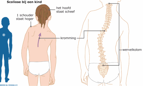 Scoliose bij een kind